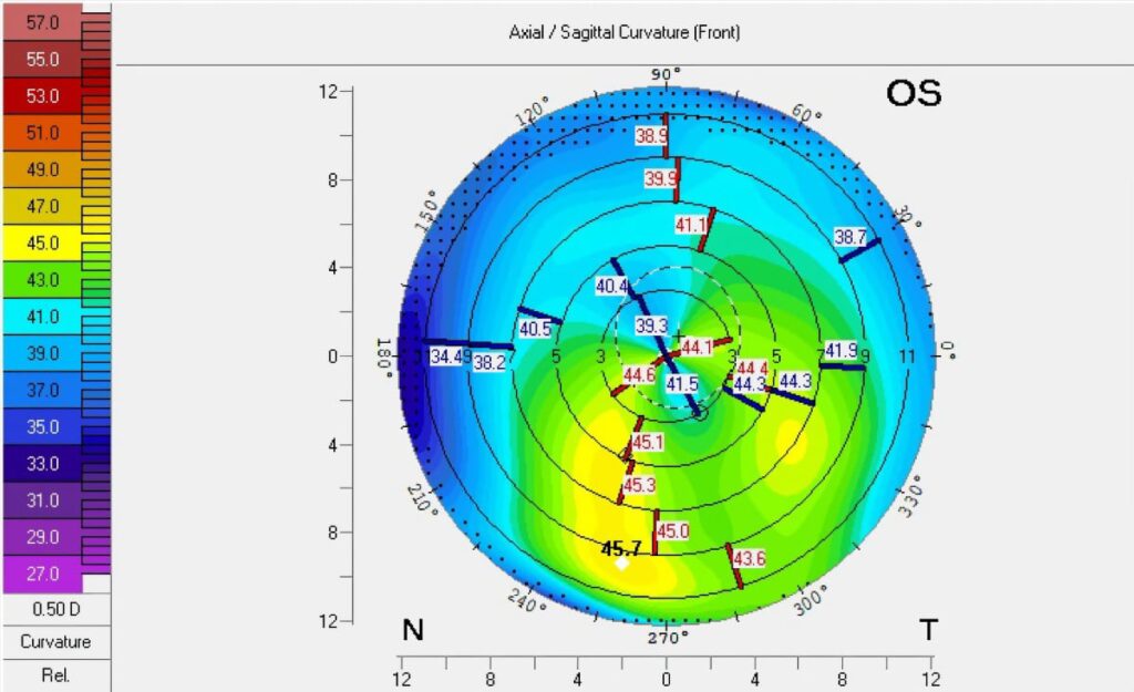 TCAT & Corneal Crosslinking | Southern Eye Specialists Laser